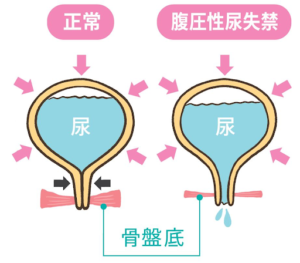 腹圧性尿失禁のメカニズムがわかる図解