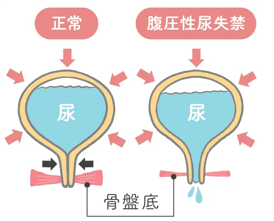 尿失禁が起こるメカニズムについての図