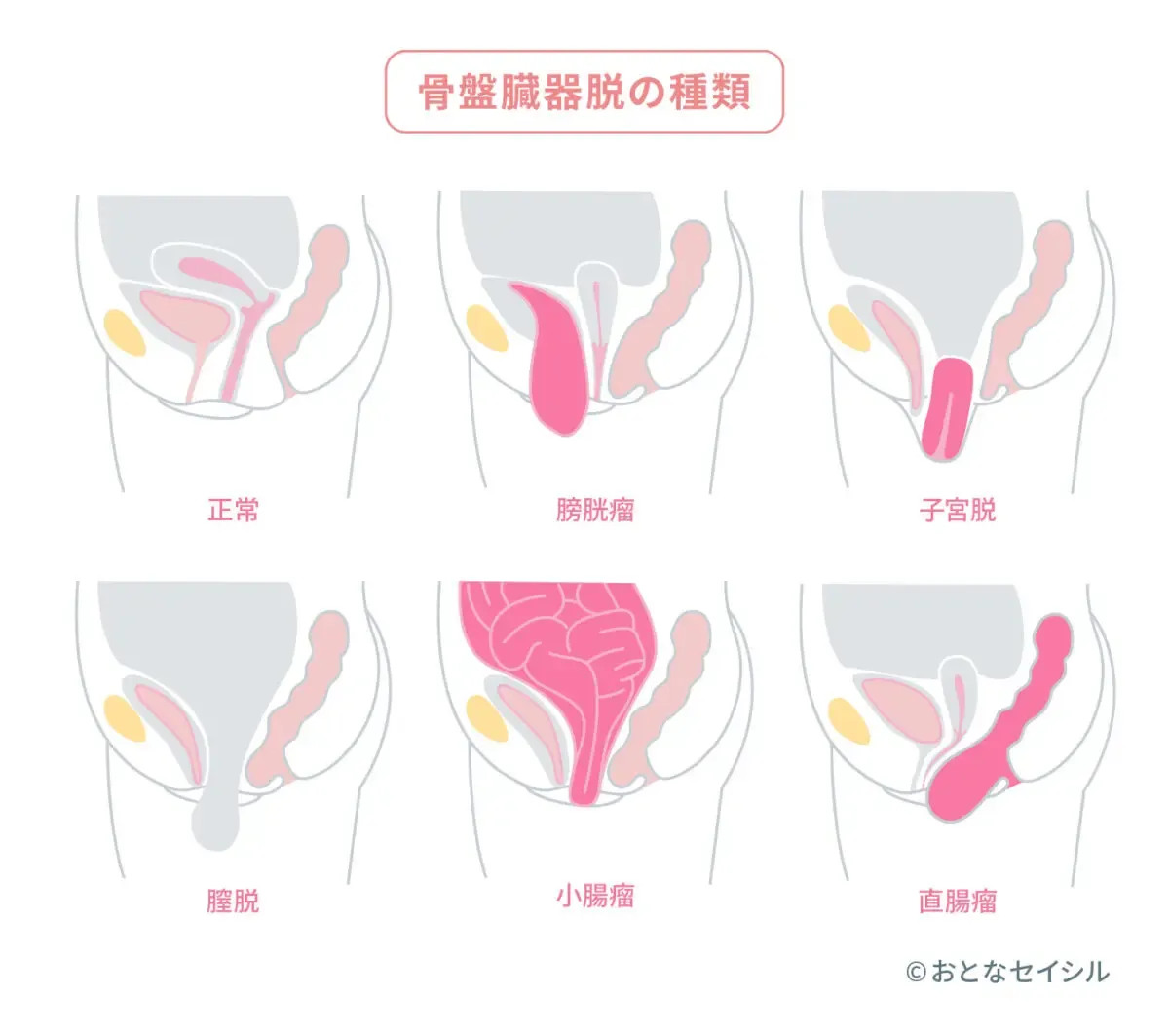 骨盤臓器脱_図解